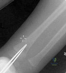 تقنية الرد عبر الجلد Joystick