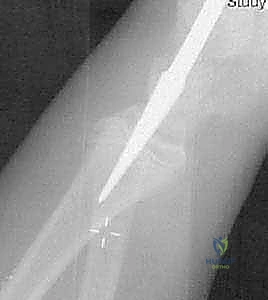 صورة توضيحية لكسور عنق الكعبرة