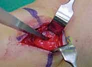 آلية السقوط وتأثيرها على العظام