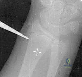 صورة توضيحية لـ كسور عنق الكعبرة عند الأطفال: دليل شامل للتشخيص والعلاج المتقدم مع الأستاذ الدكتور محمد هطيف في صنعاء