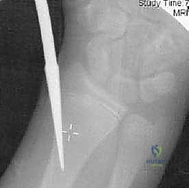 صورة توضيحية لـ كسور عنق الكعبرة عند الأطفال: دليل شامل للتشخيص والعلاج المتقدم مع الأستاذ الدكتور محمد هطيف في صنعاء