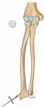 صورة طبية: كسور عنق الكعبرة عند الأطفال: دليل شامل للتشخيص والعلاج المتقدم مع الأستاذ الدكتور محمد هطيف في صنعاء