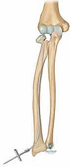 تثبيت الكسر بالأسلاك