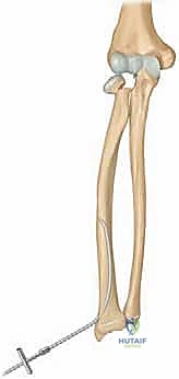 صورة توضيحية لـ كسور عنق الكعبرة عند الأطفال: دليل شامل للتشخيص والعلاج المتقدم مع الأستاذ الدكتور محمد هطيف في صنعاء