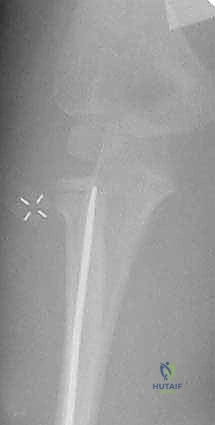 تشريح مفصل المرفق والأعصاب المحيطة