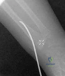 صورة توضيحية لـ كسور عنق الكعبرة عند الأطفال: دليل شامل للتشخيص والعلاج المتقدم مع الأستاذ الدكتور محمد هطيف في صنعاء