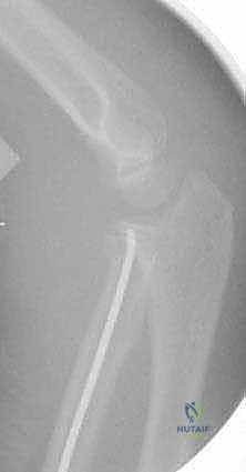 صورة طبية: كسور عنق الكعبرة عند الأطفال: دليل شامل للتشخيص والعلاج المتقدم مع الأستاذ الدكتور محمد هطيف في صنعاء