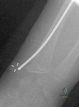 الرد المفتوح للكسر