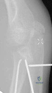 متابعة الالتئام بالأشعة