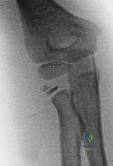 Illustration of joystick and intramedullary - Dr. Mohammed Hutaif