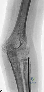 صورة طبية: كسور عنق الكعبرة عند الأطفال: دليل شامل للتشخيص والعلاج المتقدم مع الأستاذ الدكتور محمد هطيف في صنعاء