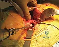 توضيح لحالة فقدان العظم وتآكل المفصل