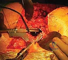 صورة توضيحية لـ مراجعة استبدال مفصل الورك الكلي في حالات فقدان العظم باستخدام السيقان المخددة: حلول متقدمة مع الأستاذ الدكتور محمد هطيف