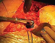 التشريح الجراحي لعظم الفخذ