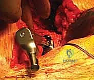 توسيع القناة العظمية