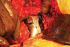 التخطيط قبل الجراحة والأشعة المقطعية