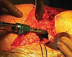 تصميم السيقان المخددة والمعيارية