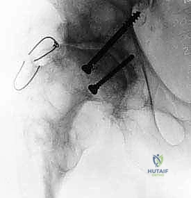 ضبط الطول باستخدام السيقان المعيارية