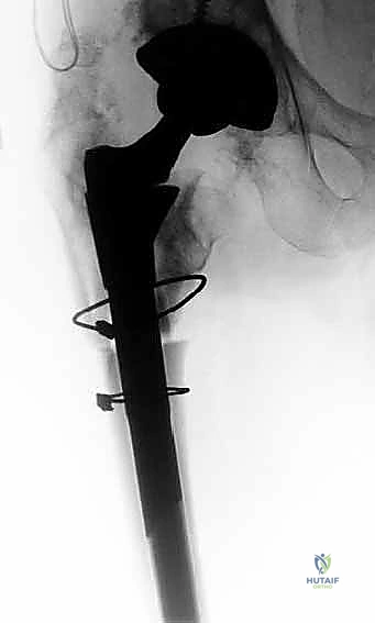 إدخال الساق المخددة