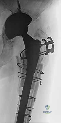 الأشعة النهائية والتثبيت