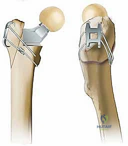 مراجعة استبدال مفصل الورك الكلي في حالات فقدان العظم باستخدام السيقان المخددة: حلول متقدمة مع الأستاذ الدكتور محمد هطيف