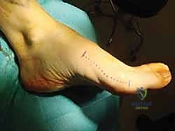 Scarf Osteotomy Masterclass: Precision Correction of Hallux Valgus