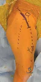 صورة شعاعية توضح خلع الورك النمائي