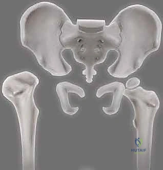 جراحة سالتر لعظم الحوض: إعادة توجيه الحُق لعلاج خلع الورك النمائي عند الأطفال