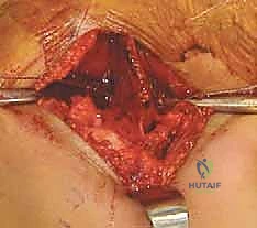 توجيه الأداة الجراحية لقطع العظم