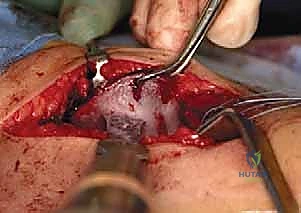 مراحل التخطيط لعملية سالتر