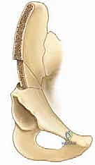 تثبيت العظم باستخدام أسياخ كيرشنر