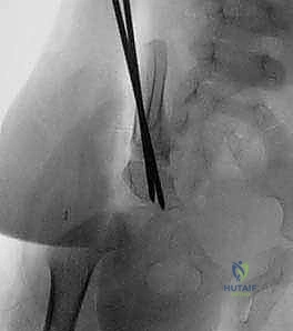 صورة إشعاعية للأسياخ بعد التثبيت
