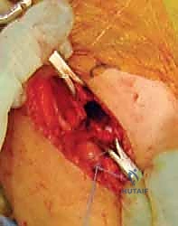 Intraoperative Surgical Step