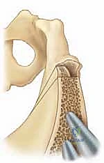 التخطيط الهندسي لزوايا الحوض قبل وبعد العملية