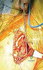 صورة إشعاعية توضح نجاح التئام العظم بعد فترة من الجراحة