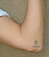 تطور أعراض متلازمة النفق المرفقي وتأثيرها على اليد