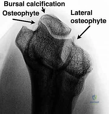 تطبيق الجبائر والعلاج التحفظي للمرفق