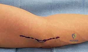 صورة توضيحية لـ متلازمة النفق المرفقي: دليل شامل لتحرير العصب الزندي وعلاجه في اليمن