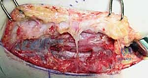 صورة توضيحية لـ متلازمة النفق المرفقي: دليل شامل لتحرير العصب الزندي وعلاجه في اليمن