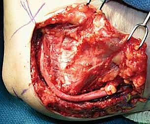 التشخيص السريري الدقيق لانضغاط العصب