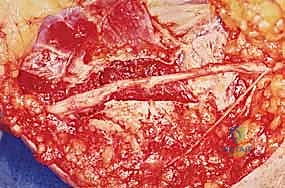 صورة توضيحية لـ متلازمة النفق المرفقي: دليل شامل لتحرير العصب الزندي وعلاجه في اليمن