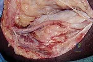 صورة توضيحية لـ متلازمة النفق المرفقي: دليل شامل لتحرير العصب الزندي وعلاجه في اليمن