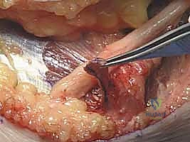 متلازمة النفق المرفقي: دليل شامل لتحرير العصب الزندي وعلاجه في اليمن