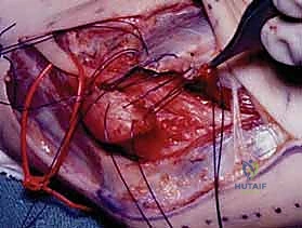 صورة توضيحية لـ متلازمة النفق المرفقي: دليل شامل لتحرير العصب الزندي وعلاجه في اليمن