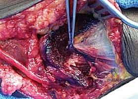 صورة توضيحية لـ متلازمة النفق المرفقي: دليل شامل لتحرير العصب الزندي وعلاجه في اليمن