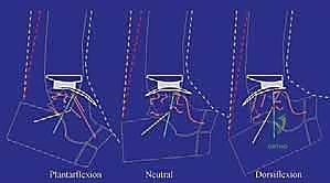 The BOX Total Ankle Arthroplasty: An Intraoperative Masterclass for Physiologic Motion Restoration