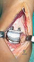 Intraoperative Surgical Step