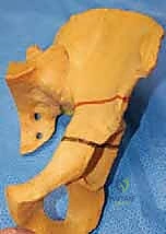 تشريح مفصل الورك للأطفال وتطور النمو