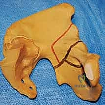 التغطية العظمية لرأس الفخذ