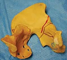 علامات عدم التماثل في الطيات الجلدية